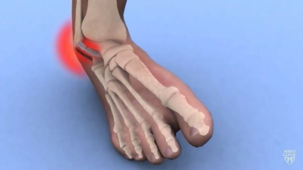 How To Speed Up Foot Sprain Recovery