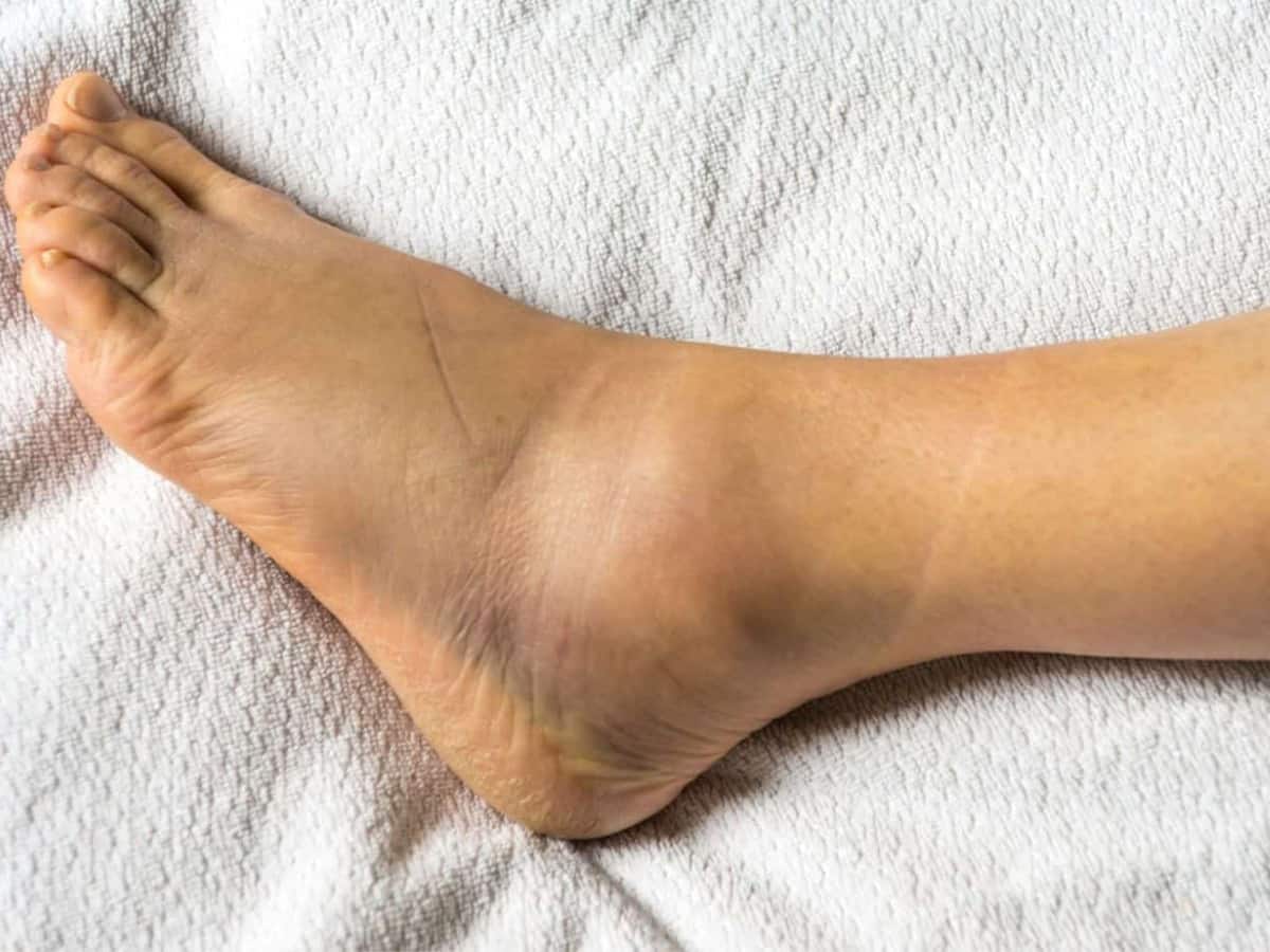 How To Care For A Sprained Foot At Night