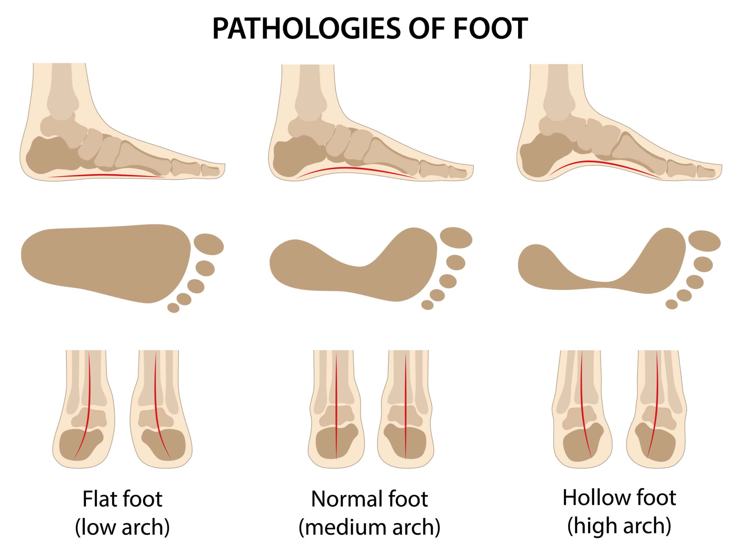 The Connection Between Footwear And The Risk Of A Sprained Foot