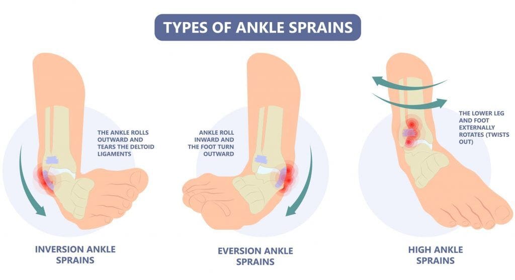 How To Alleviate Itching And Irritation In A Sprained Foot