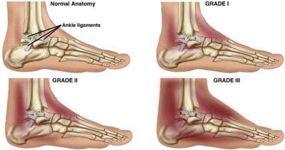 Most Effective Ways To Prevent Muscle Atrophy In A Sprained Foot