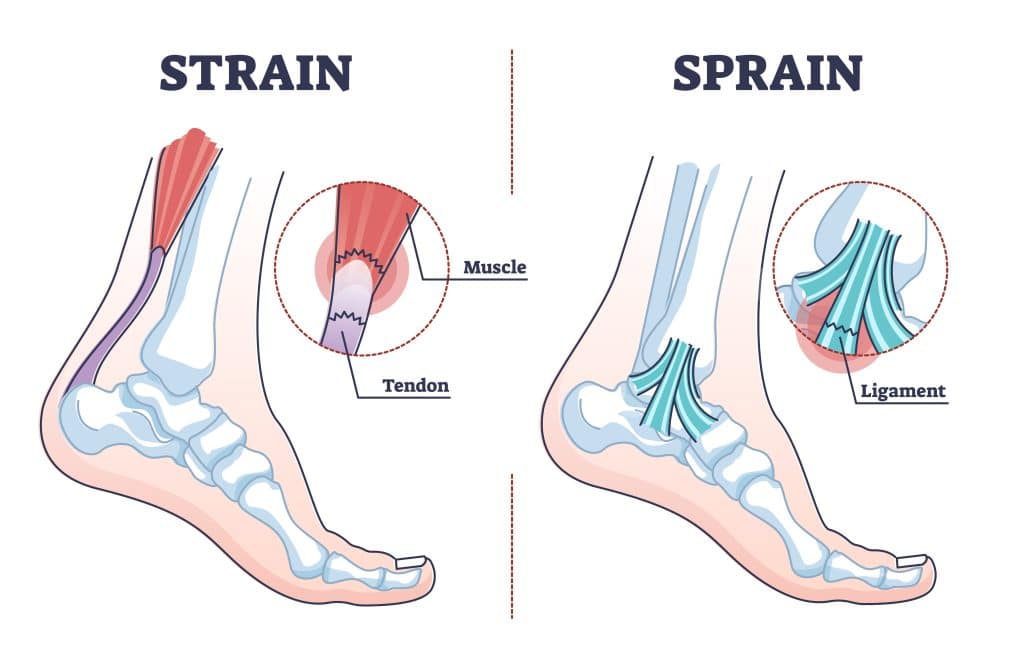 Avoiding Common Complications Of A Sprained Foot