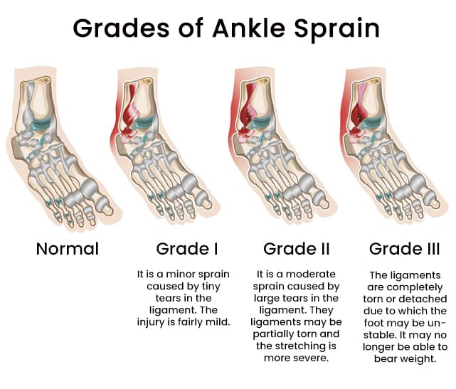 Most Common Symptoms Of A Sprained Foot