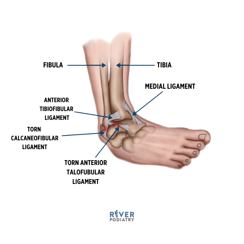 How To Avoid Aggravating A Sprained Foot