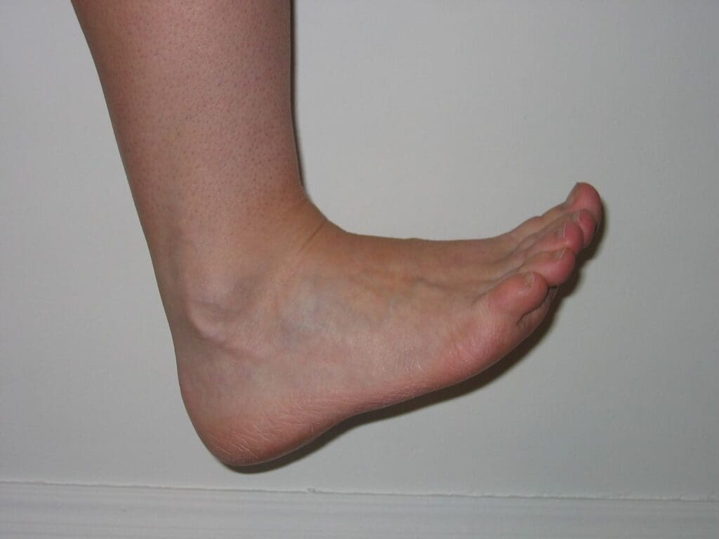 How To Prevent Muscle Atrophy During Foot Sprain Recovery How To Prevent Muscle Atrophy During Foot Sprain Recovery