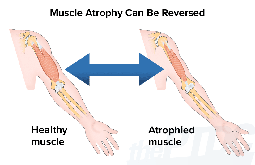 How To Prevent Muscle Atrophy During Foot Sprain Recovery How To Prevent Muscle Atrophy During Foot Sprain Recovery
