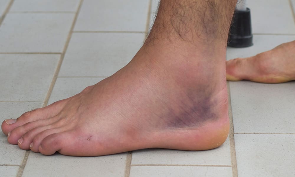 How To Recognize The Early Signs Of A Sprained Foot How To Recognize The Early Signs Of A Sprained Foot