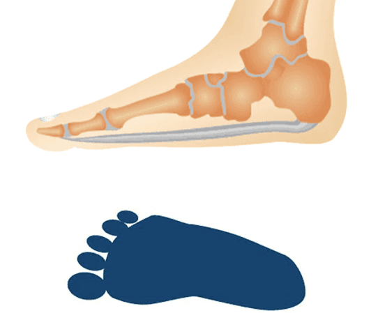 Buyers Guide To Orthotic Insoles For Sprained Foot Buyers Guide To Orthotic Insoles For Sprained Foot