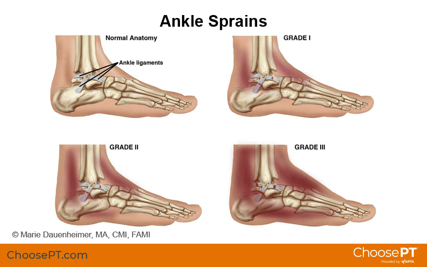 Navigating Physical Intimacy And Relationships During A Sprained Foot Recovery