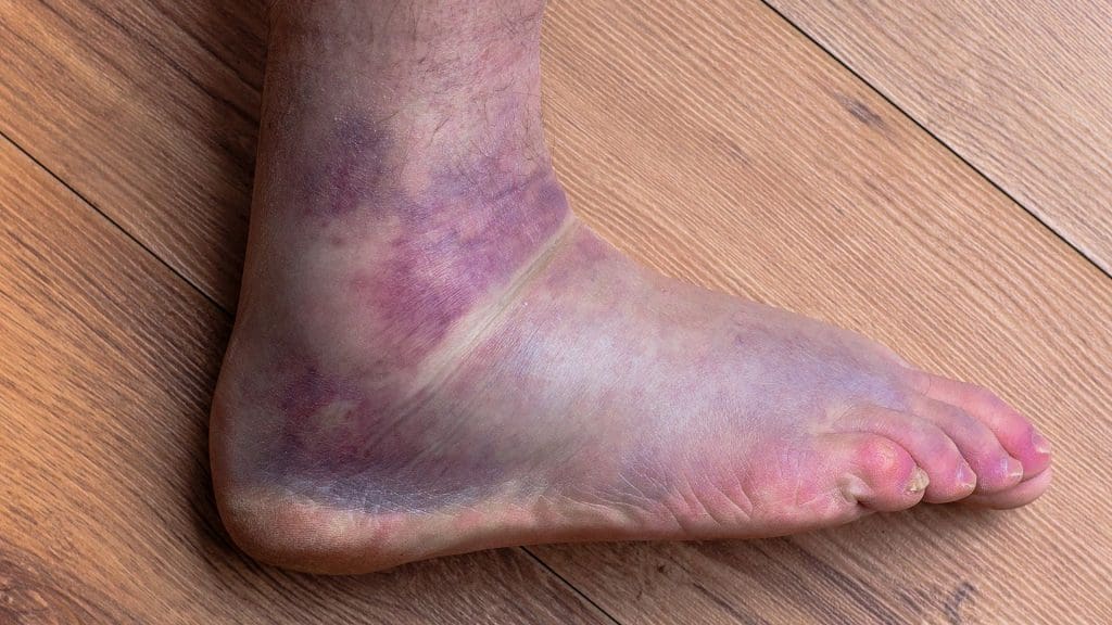 Top Ways To Keep The Sprained Foot Limber And Mobile