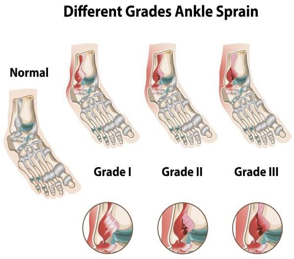 Top Ways To Speed Up The Recovery From A Sprained Foot Top Ways To Speed Up The Recovery From A Sprained Foot