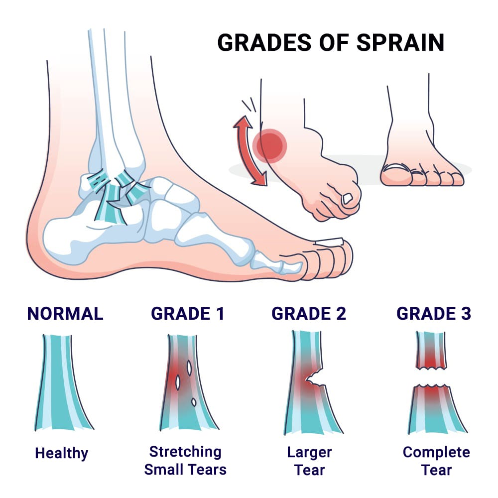 Benefits Of Physical Therapy For Sprained Foot