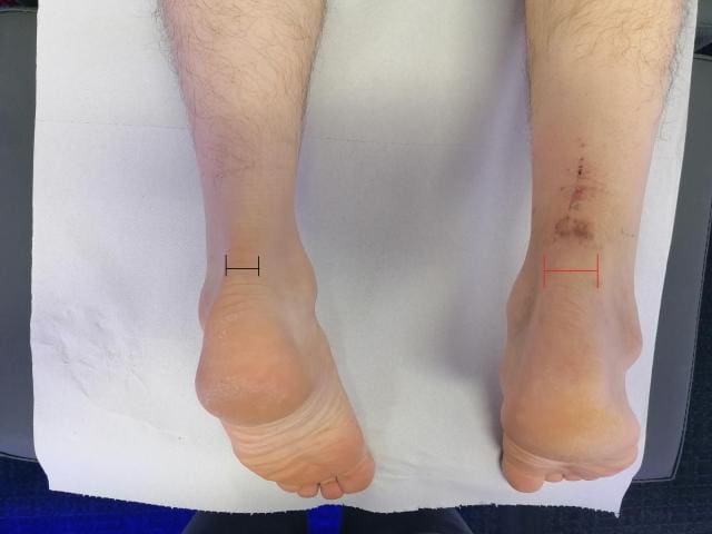 Top Ways To Reduce Scar Tissue Formation During Foot Sprain Recovery Top Ways To Reduce Scar Tissue Formation During Foot Sprain Recovery