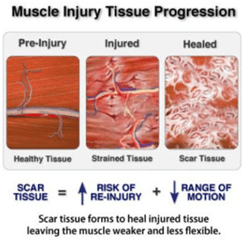 Top Ways To Reduce Scar Tissue Formation During Foot Sprain Recovery Top Ways To Reduce Scar Tissue Formation During Foot Sprain Recovery